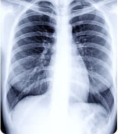 Chest X-Ray